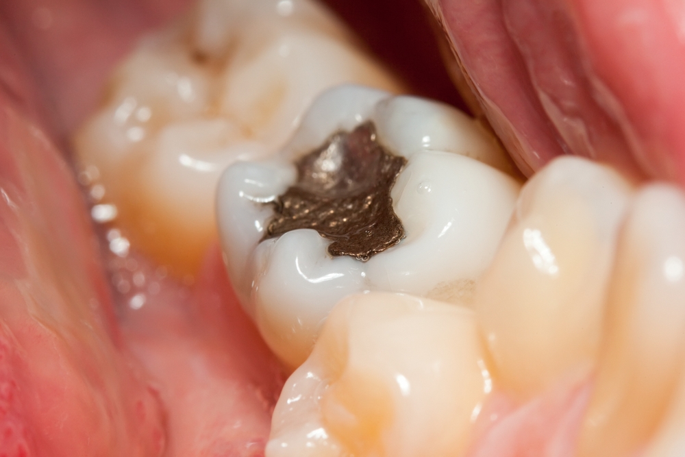 Otturazione con amalgama d'argento Otturazione con amalgama d'argento
