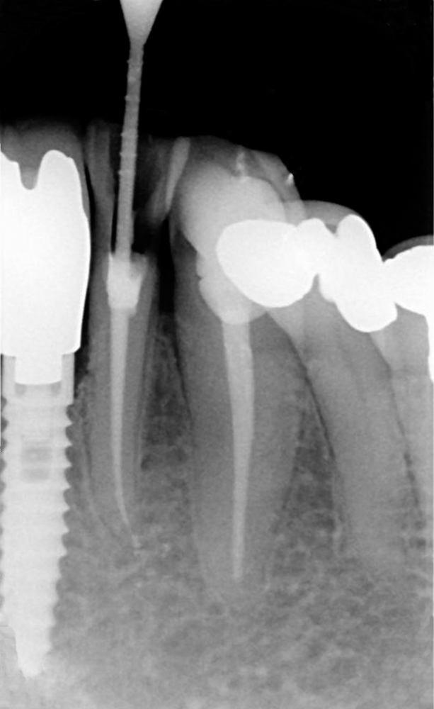 Trattamento endodontico Trattamento endodontico